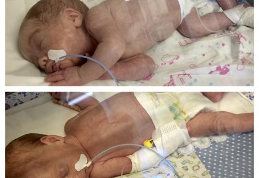 Наши малышки в реанимации